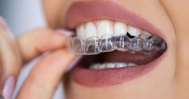 invisalign em capina grande